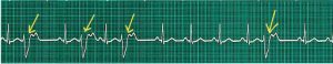 Electrocardiogram of premature ventricular contractions